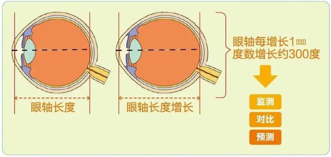 头条眼睛为什么会近视作文事理说明文，有关眼睛为什么会近视的详情