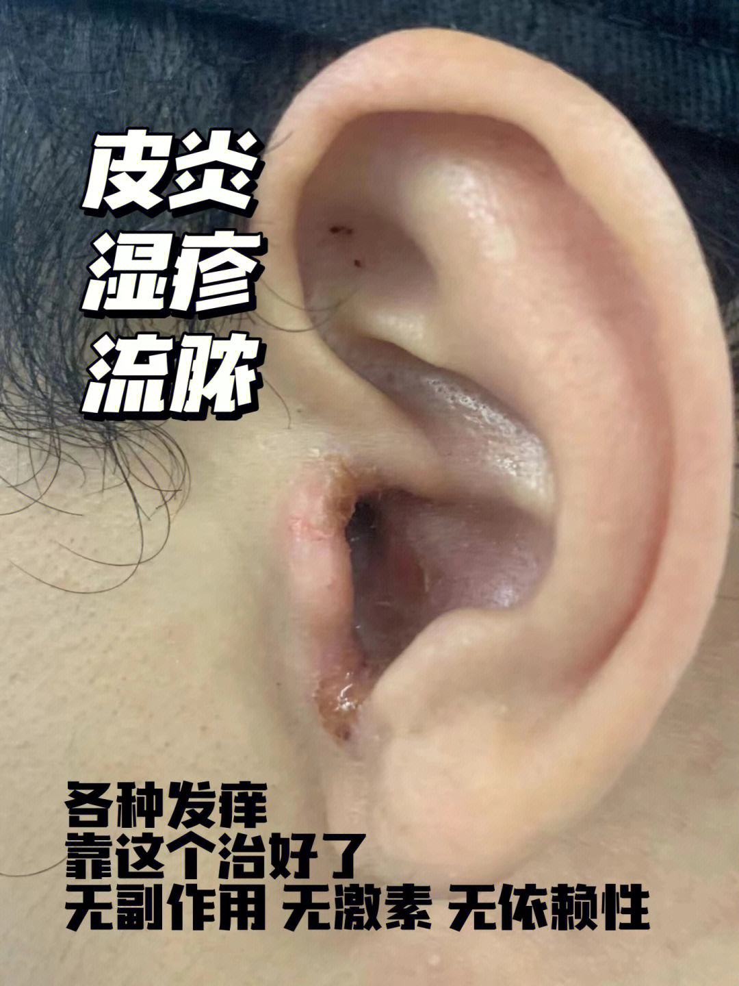 热点大腿内侧湿疹多久能好以及湿疹多久能好的分享