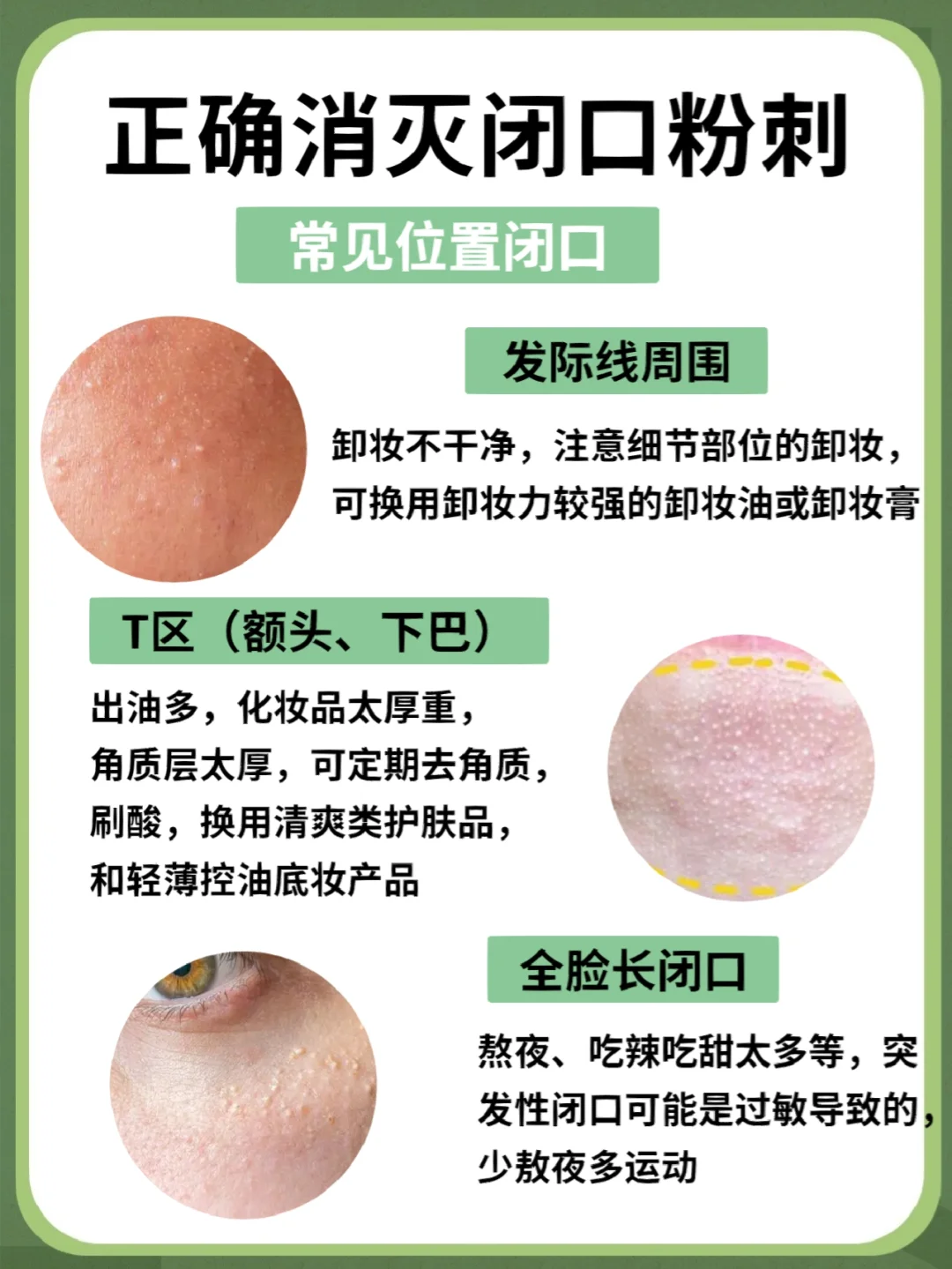 青春痘一般多久会消失14岁包括青春痘一般多久会消失的详细情况