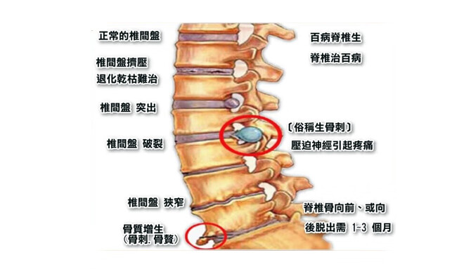 受凉坐骨神经痛的症状有哪些和坐骨神经痛的症状有哪些的详细介绍