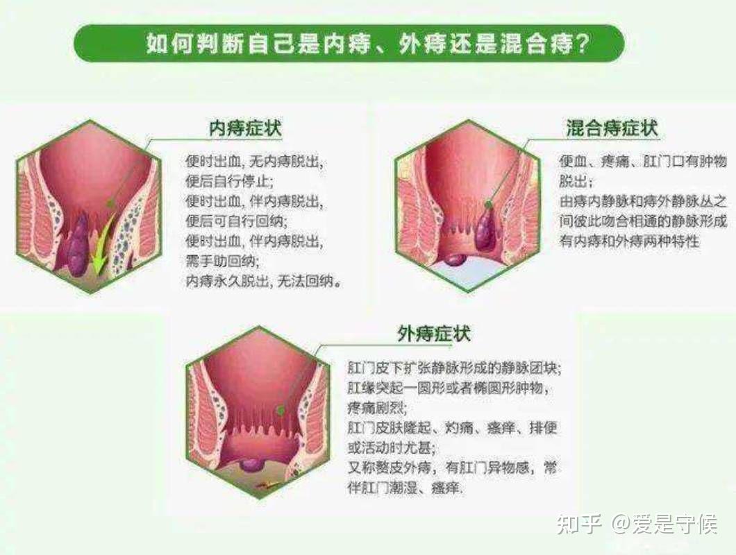 外痔的肉球如何消除用什么药包括外痔的肉球如何消除的具体内容