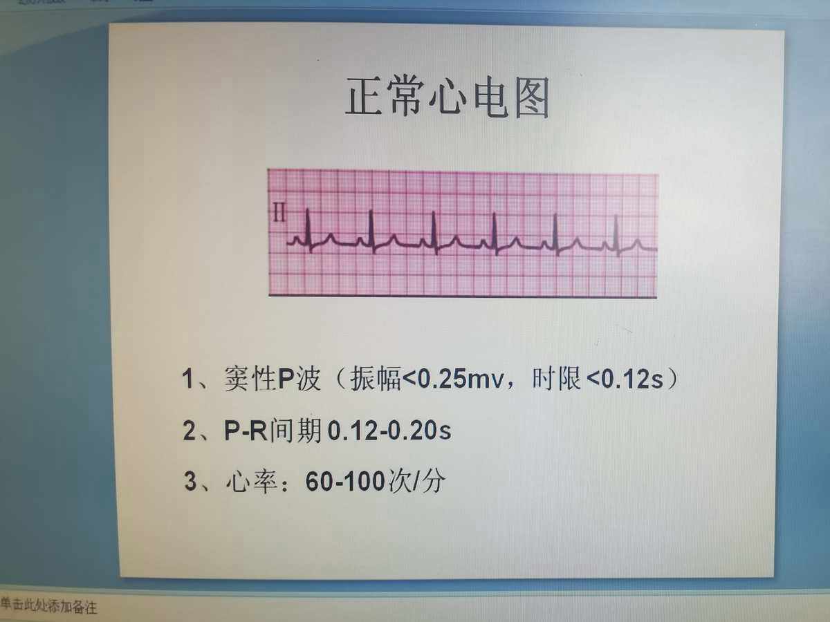 如何看心电图图解和如何看心电图的详细介绍