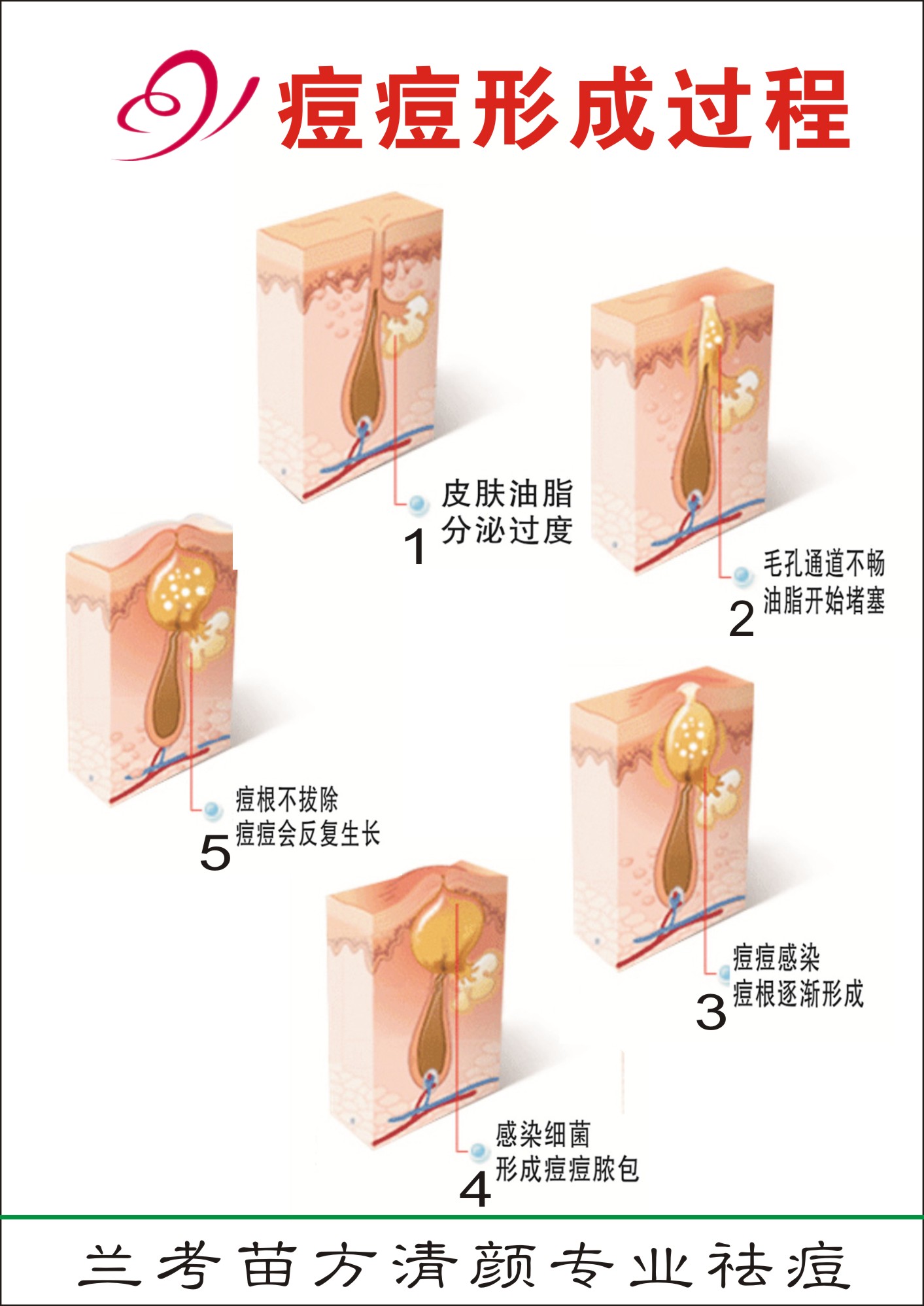 头条如何治疗痤疮杆菌，有关如何治疗痤疮的详情