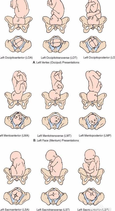 头条孕晚期左枕前位是什么意思，有关枕前位是什么意思的详情