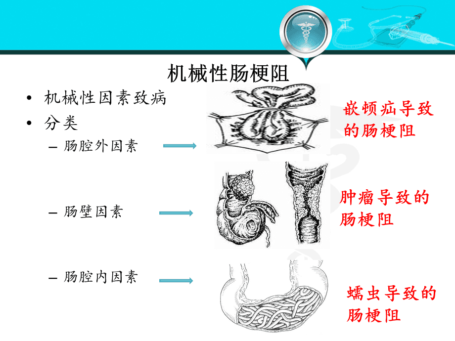 热点三岁小孩肠梗阻是因为什么原因引起的以及肠梗阻是因为什么原因引起的的分享