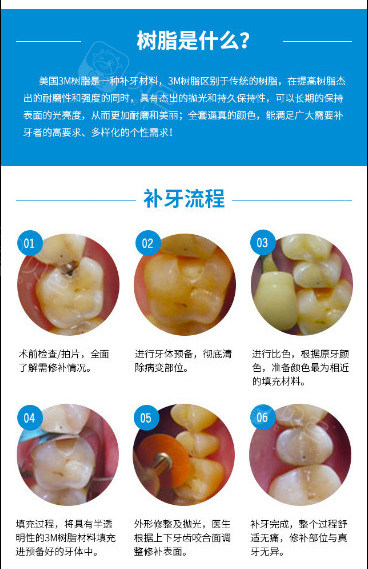 3m树脂补牙能维持多久包括树脂补牙能维持多久的具体内容