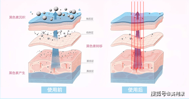 如何美白牙齿最有效果与如何美白的原因