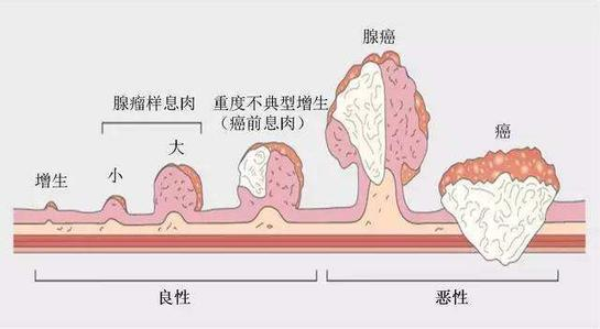 为什么子宫会长息肉是什么原因引起的和为什么子宫会长息肉的情况说明