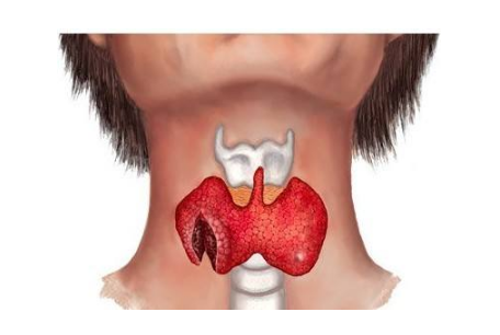 什么是甲状腺亢进病与什么是甲状腺亢进的原因