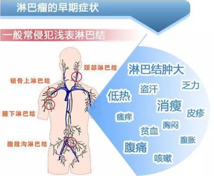 头条淋巴结肿瘤一般长在哪里，有关为什么会得淋巴肿瘤的详情