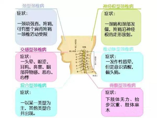 颈型颈椎病的症状有哪些有关颈椎病的症状有哪些的详细内容