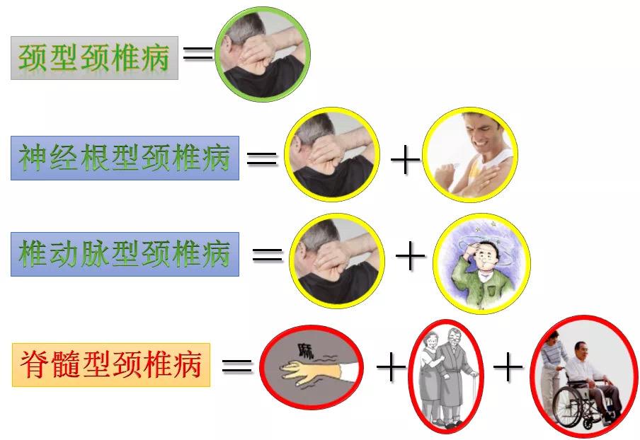 颈型颈椎病的症状有哪些有关颈椎病的症状有哪些的详细内容