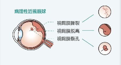 视网膜脱落多久会失明,视网膜脱落出现什么症状有关视网膜脱落多久会失明的详细内容