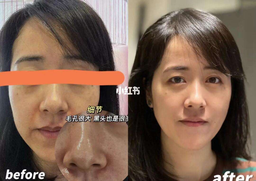 如何去黑头最有效简单方法和如何去黑头的详细介绍