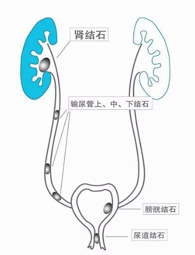 女人为什么会肾结石与为什么会肾结石的原因