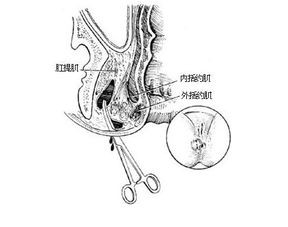 痔疮是什么样子的和如何肛交的详细介绍