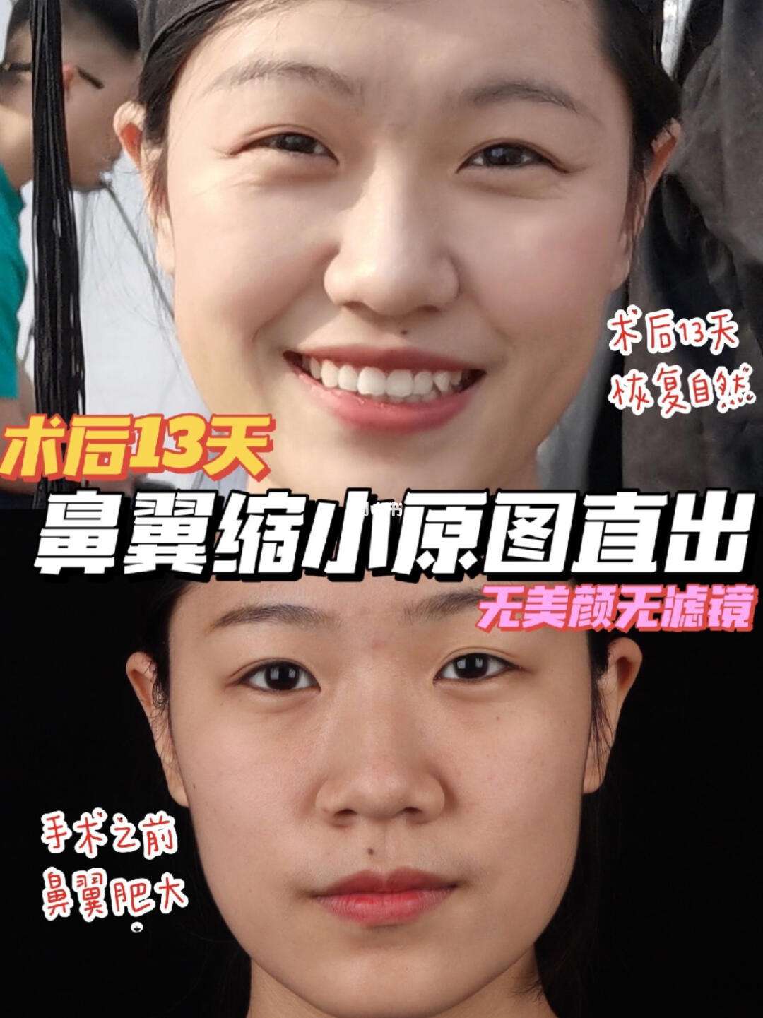 如何缩小鼻翼小窍门包括如何缩小鼻翼的详细情况