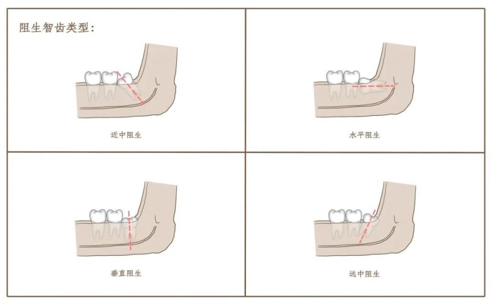 拔牙后多久能装假牙多久可以吃东西和拔牙后多久能装假牙的详细介绍