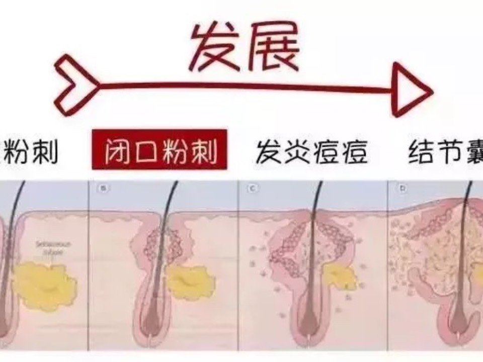 如何去除青春痘男生以及如何去除青春痘的情况分析