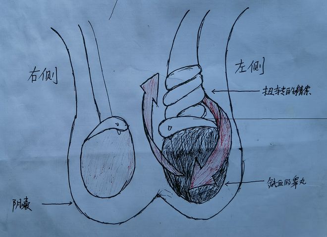 如何判断睾丸是否扭转和恢复正常与如何判断睾丸是否扭转的原因