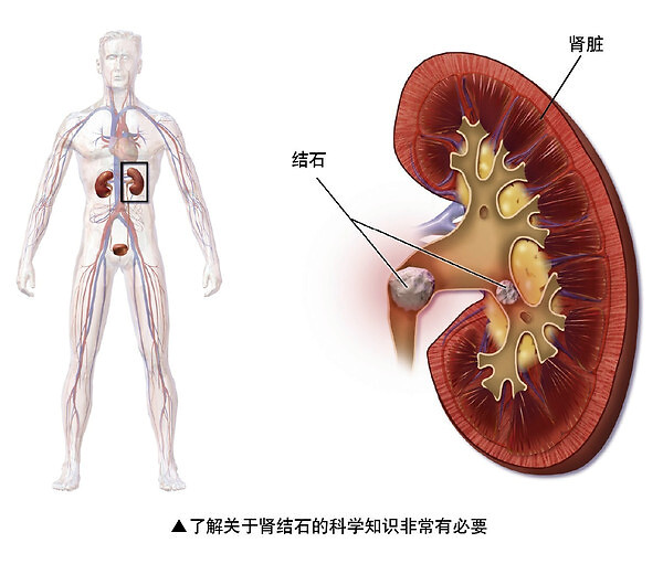 为什么会有肾结石和肾积水包括为什么会有肾结石的详细情况