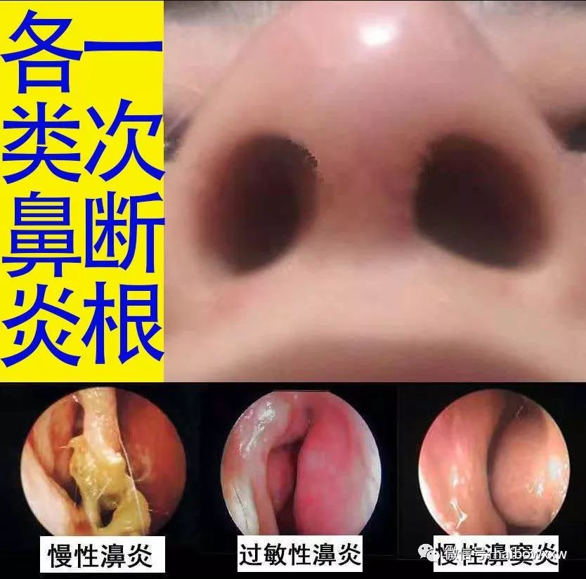 过敏性鼻炎的症状都有哪些有关鼻炎的症状都有哪些的详细内容