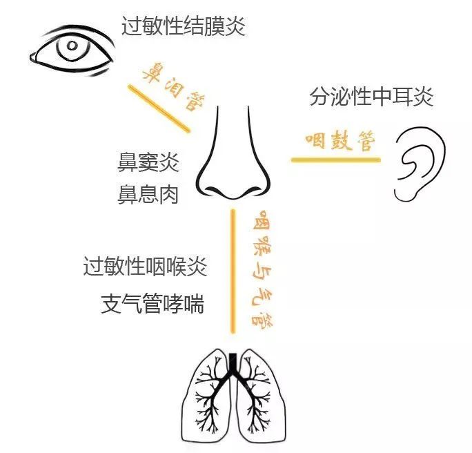 过敏性鼻炎的症状都有哪些有关鼻炎的症状都有哪些的详细内容