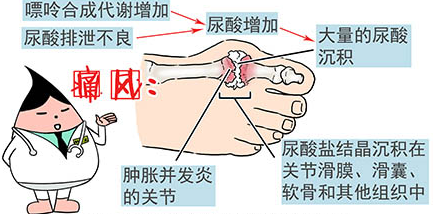 如何治疗痛风吃什么药好以及如何治疗痛风的情况分析