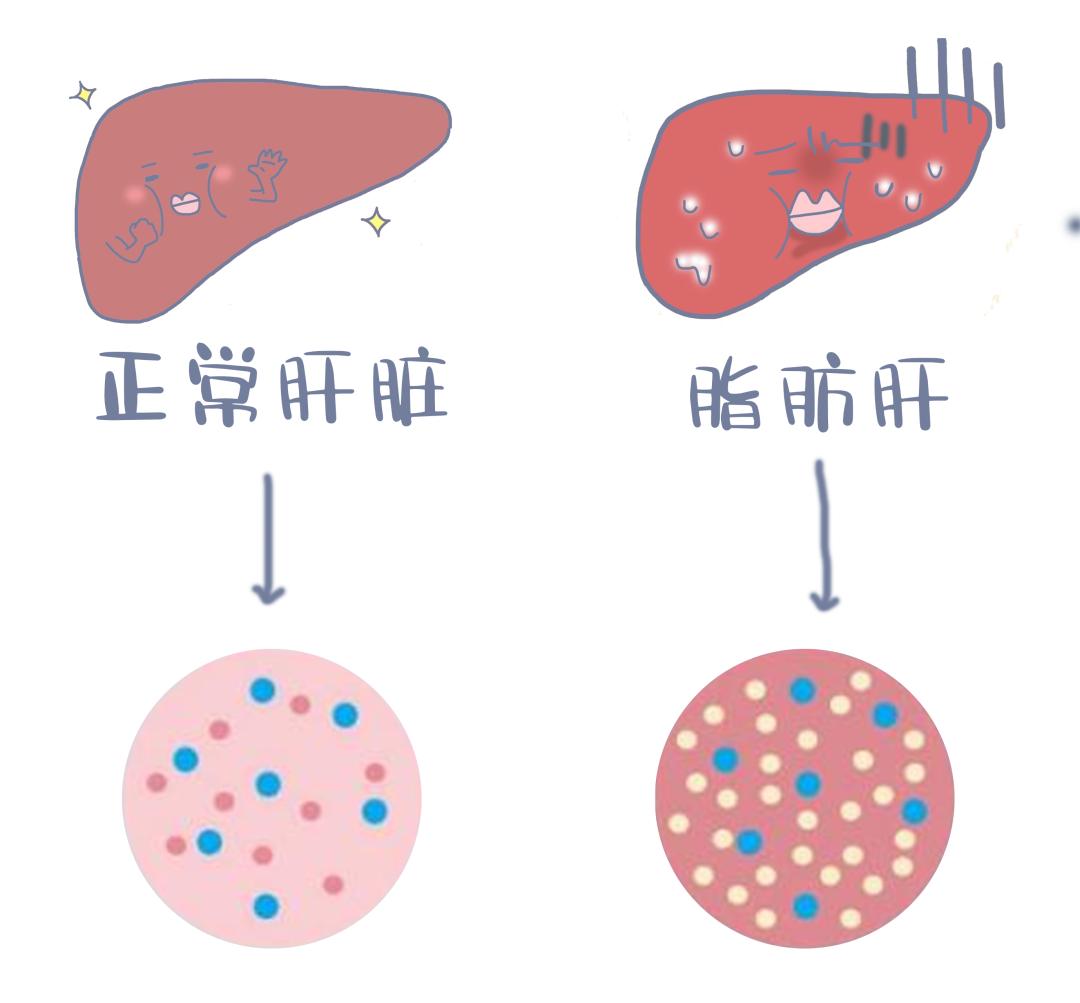 脂肪肝是如何形成的如何解决，关于脂肪肝是如何形成的详细情况