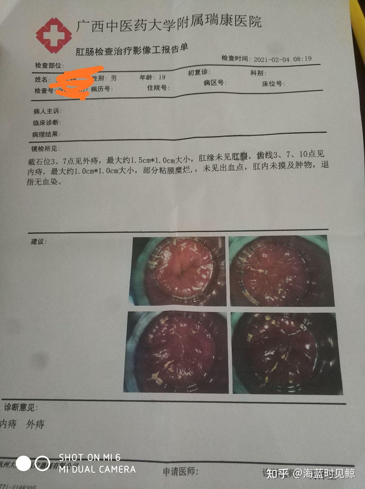 结肠炎的症状有哪些症状，关于直肠炎有哪些症状详细情况