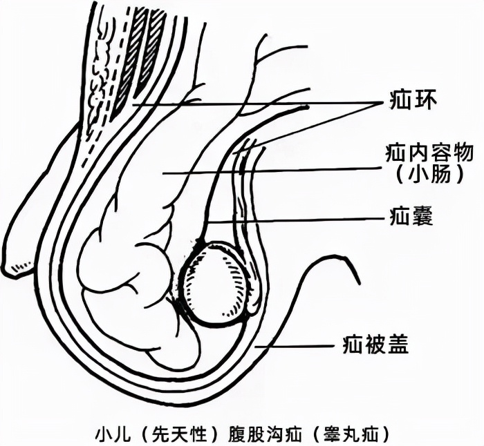 小肠疝气的症状表现有哪些以及疝气的症状表现有哪些的情况分析