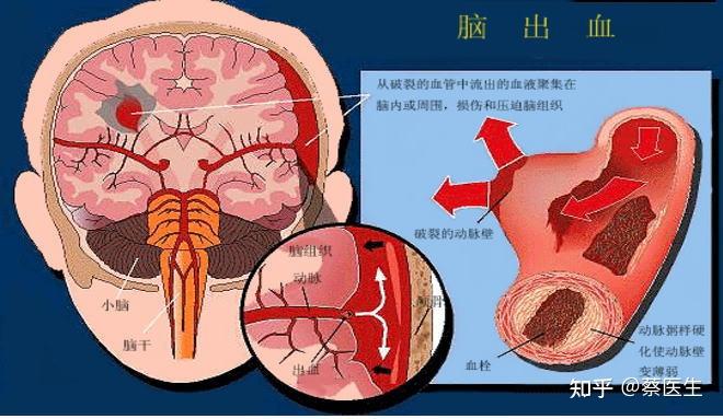 头条为什么会低血糖，有关为什么会的详情