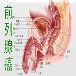 前列腺癌症状有哪些PSA值和前列腺癌症状有哪些的情况说明