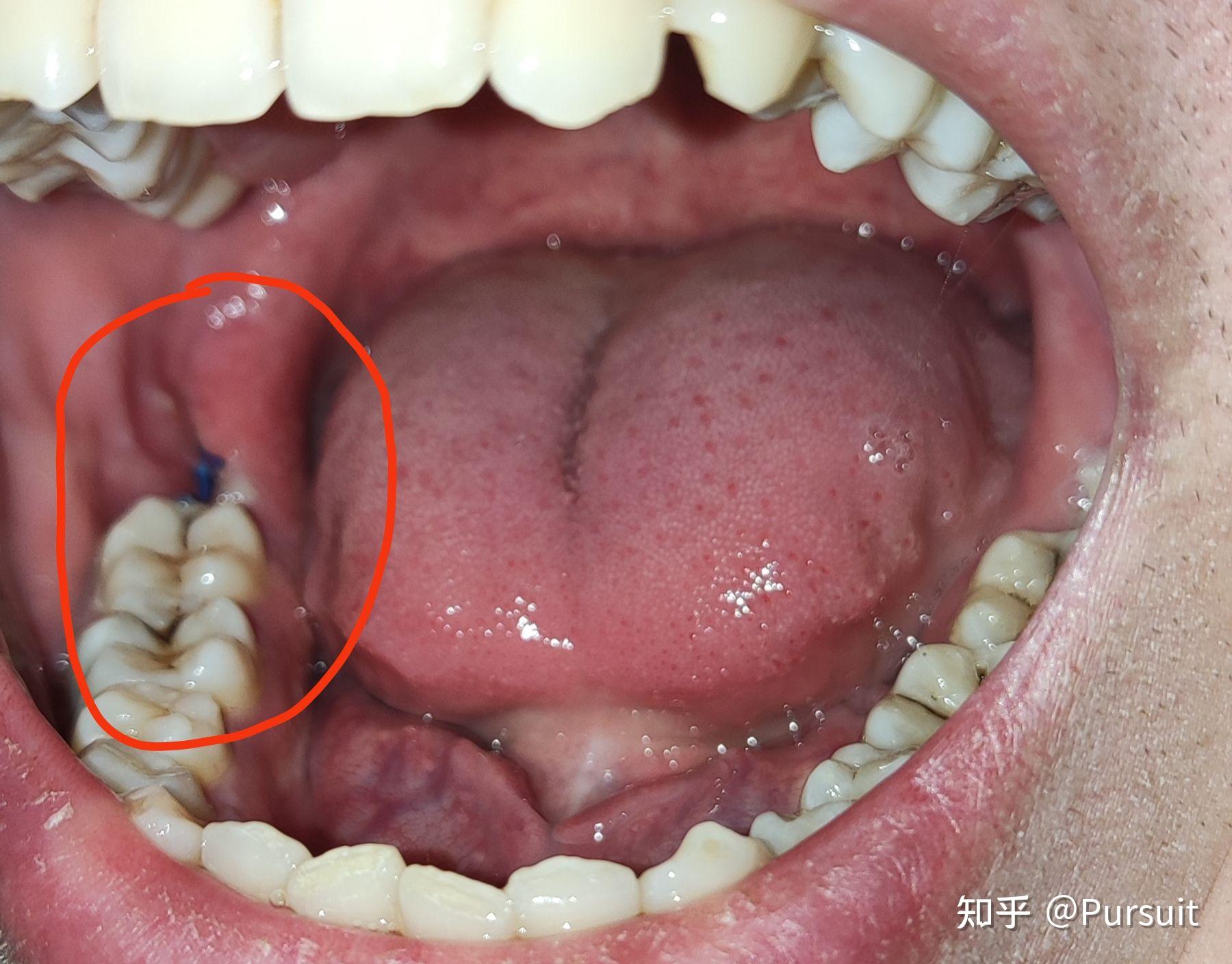 热点拔完智齿多久可以正常吃饭喝水以及拔完智齿多久可以正常吃饭的分享