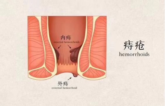 痔疮的症状有哪些早中晚期包括痔疮的症状有哪些的详细情况