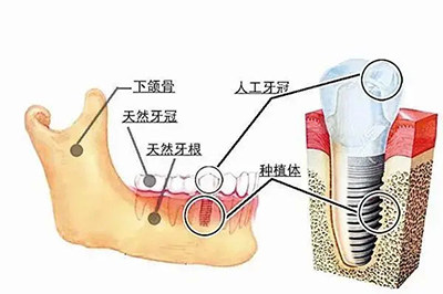 种牙能用多久?和种牙能用多久的详细介绍