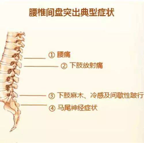 头条腰间盘突出有哪些症状，有关腰间盘突出有哪些症状的详情