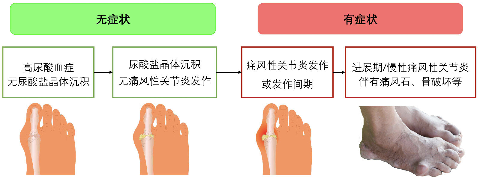 尿酸高有哪些症状男性有关尿酸高有哪些症状的详细内容