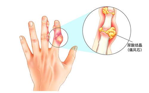 胳膊痛风有哪些症状表现包括痛风有哪些症状表现的具体内容