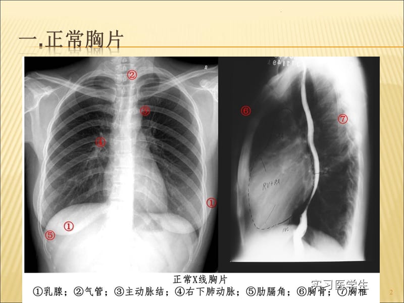 分享如何看胸片影像ct，关于如何看胸片的详情