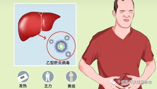 甲肝症状表现有哪些以及乙肝症状表现有哪些的情况分析