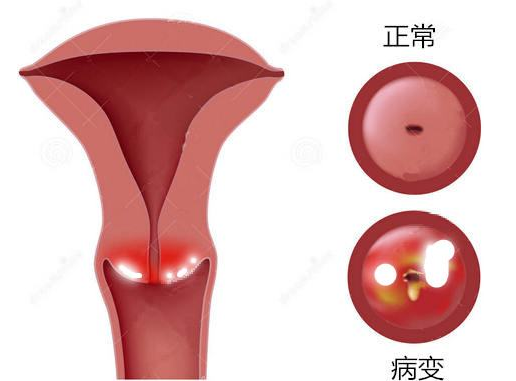 热点宫颈糜烂的症状有哪些图片以及宫颈糜烂的症状有哪些的分享