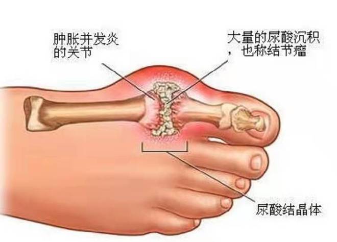 痛风克星六味地黄丸，关于如何消除痛风石详细情况