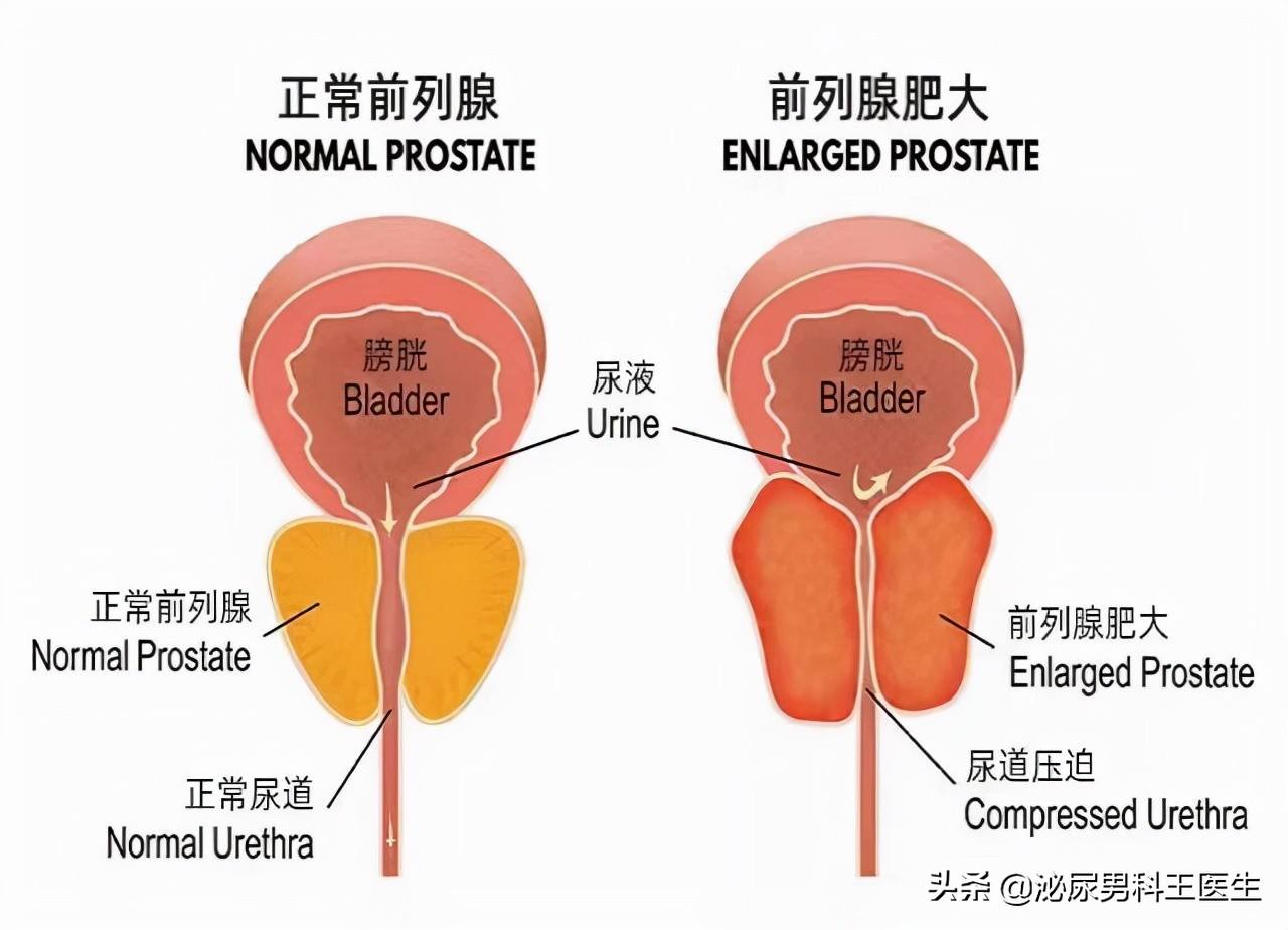 头条前列腺炎如何根治才是最好的，有关前列腺炎如何根治的详情