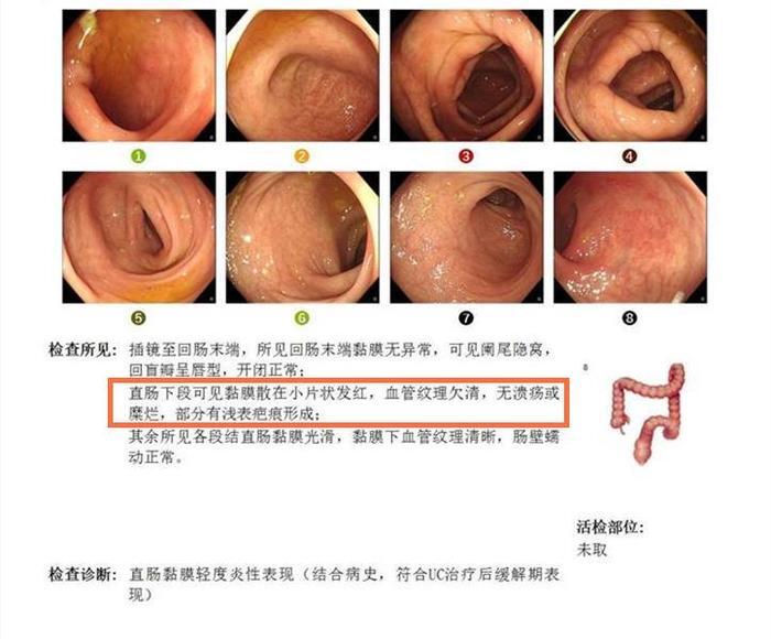 分享溃疡性结肠炎的症状有哪些，关于肠炎的症状有哪些的详情