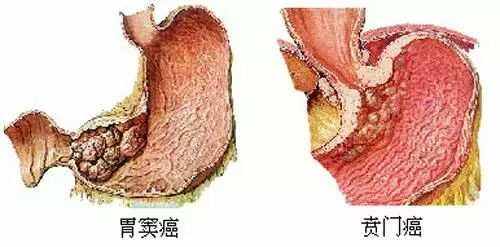 分享胃癌的早期症状有哪些?4大症状要警惕，关于胃癌的早期症状有哪些的详情