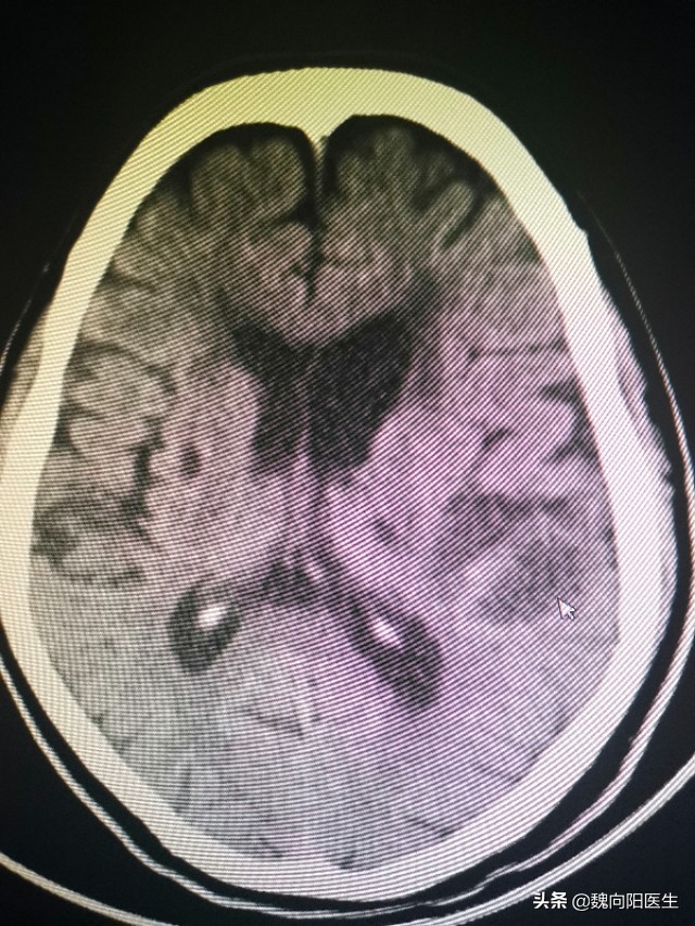 脑梗死多久能恢复正常人包括脑梗死多久能恢复正常的详细情况