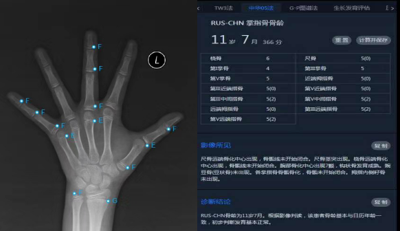 热点儿童如何测骨龄以及如何测骨龄的分享