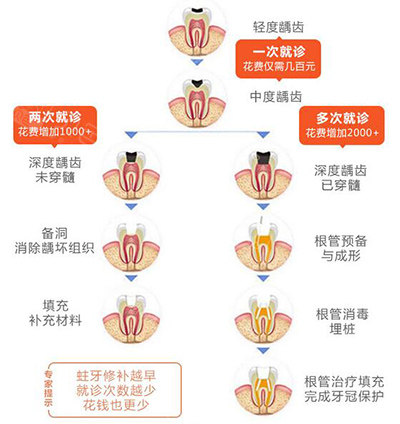 补牙为什么要分三次,一次一付钱么与补牙为什么要分三次的原因