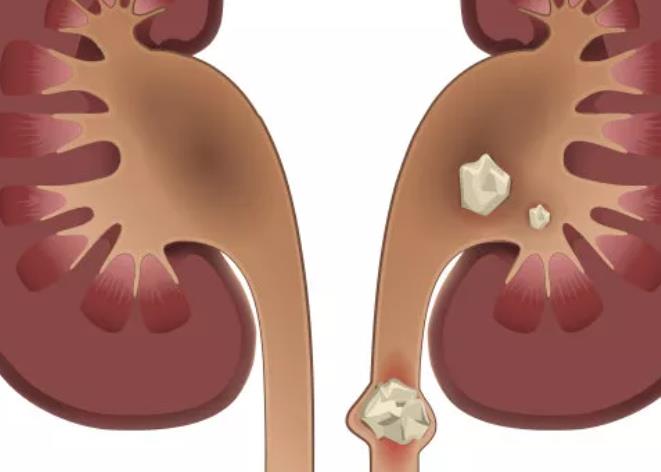 女生肾结石会有哪些症状包括肾结石会有哪些症状的具体内容
